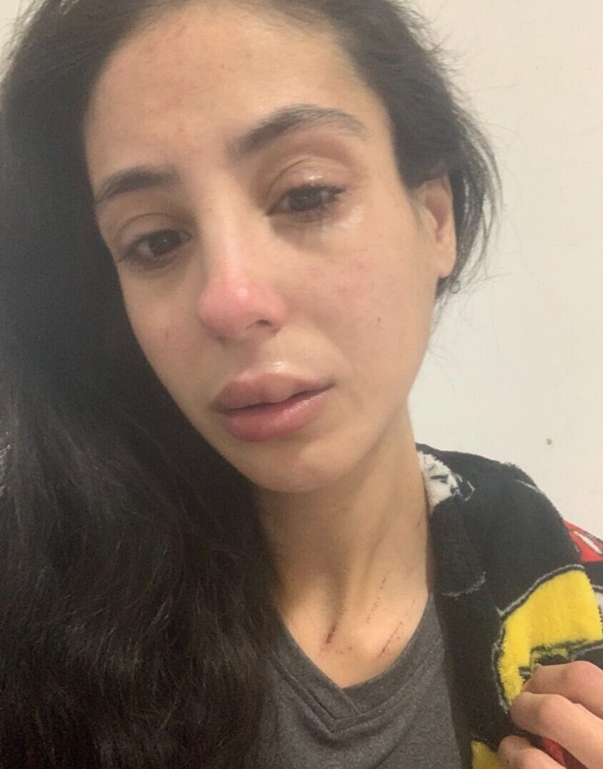 טל אלקירי בעקבות תקיפת בעלה